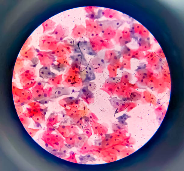 squamous cell Carcinoma treatment Orange CA