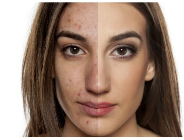 basal cell carcinoma treatment Long Beach CA