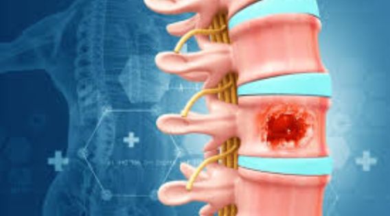 Spine Tumors Treatment in India: Symptoms, Causes, and Risk Factors