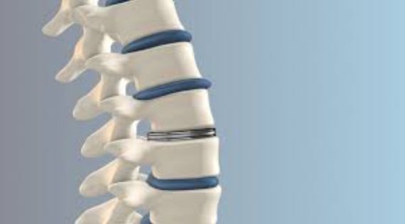 Disc Replacement Surgery in India: Contact the Best Cervical Spine Surgeon in India