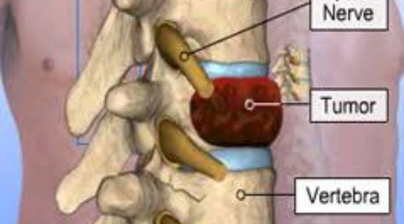 Spine Tumor Surgery in Kolkata: Contact the Best Spine Neurosurgeon in India