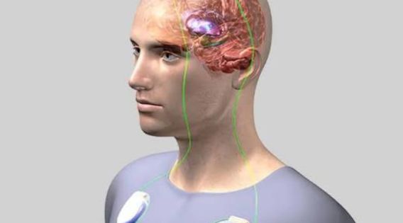 Life After DBS Surgery: DBS Surgeon in Kolkata, India