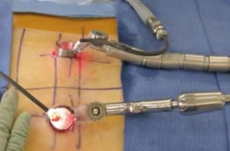 Minimally Invasive Spine Surgery India: Meet the Top Spine Surgeon in Kolkata