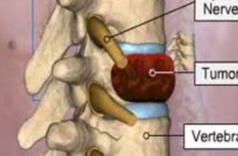 Spine Tumor Surgery in India: Consult Top Spine Neurosurgeon in Kolkata, India