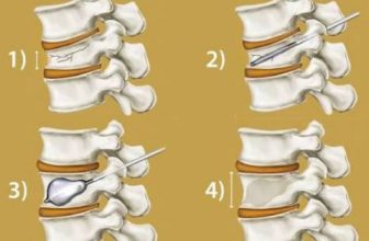 Vertebroplasty and Kyphoplasty Recovery Time in the Elderly: What to Expect