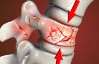 Spine Fracture Treatment in Kolkata: Vertebroplasty and Kyphoplasty Recovery Time in the Elderly