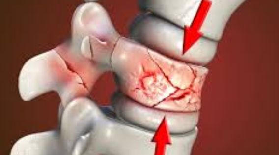 Spine Fracture Treatment in Kolkata: Vertebroplasty and Kyphoplasty Recovery Time in the Elderly