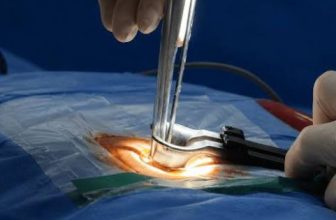 Minimally Invasive Spine Surgery Recovery Time: Consult the Top Spine Surgeon in Kolkata, India