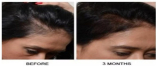 Top Non-Surgical Hair Loss Treatments in New Jersey: A Complete Review