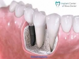 Help in Making Affordable Dental Implants San Diego