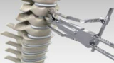 Disc Replacement India: Cervical Disc Replacement Surgery in Kolkata, India