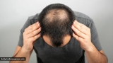 Hair Transplant for Women: Can It Be Effective and Safe?