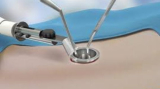 Minimally Invasive Spine Surgery in India for Faster Recovery