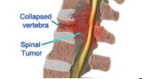 Spinal Tumor Treatment in India: Expert Surgery & Recovery