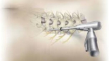 Spine Surgery in India: Quick Recovery in Minimally Invasive Spine Surgery
