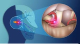 Trigeminal Neuralgia Surgery in Kolkata: Best Surgeon for Trigeminal Neuralgia Treatment