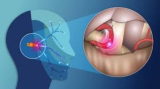 Trigeminal Neuralgia Treatment & Surgery in Kolkata, India