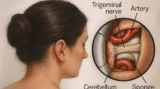 Trigeminal Neuralgia Treatment in India: Expert Advice and Care