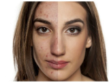 What Are the Best Options for Basal Cell Carcinoma Treatment in Long Beach CA?