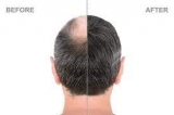 7 HAIR TRANSPLANT MYTHS AND FACTS
