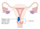 Endometrial Cancer Therapeutics Market Research Report by Leading Key Players