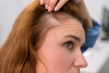 Things to know before planning your hair transplant in Delhi
